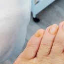이천 문제성 발 전문#라파엘