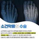 한미정형외과의원 | 새끼발가락이 옆으로 튀어나와 아픈 소건막류 원인과 치료법, 새끼발가락수술 전-후 후기