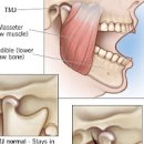 턱관절 장애 및 (턱통증 턱근육통증 턱소리) 이미지