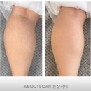 어바웃메디컬 | 튼살커버 가격, 부작용, 종아리 메디컬타투 후기