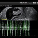 어매밥줘 | 임신 9주·10주·11주 | 3주째 피고임과 갈색혈, 입덧 최고조 극복기🫠 입덧 완화 음식 추천🍋