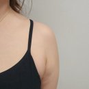 SPL | 분당서현피부과 SPL 팔뚝 다이어트 찐 후기