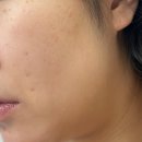 바디조짐 | 피부염, 지금까지 써봤던 면역억제, 스테로이드연고 후기+홈케어