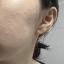 천욱부피부과의원 네이버블로그