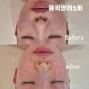 아이미뷰티끄 - 4970 | 아이미뷰티끄에서 만난 파주 페이스핏톡스, 슬림한 턱선 솔직 후기!