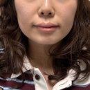 분당-300 | 서현역피부과 고주파리프팅 텐써마300샷 솔직후기 통증, 효과, 유지기간 총 정리