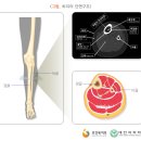 만성 골수염 : 개요 이미지