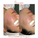 송도피부관리 에스떼리밋