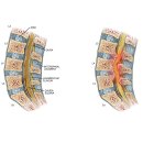 UR(의정부시)-[평화로]-하-82 | 의정부 척추관협착증, 허리통증 및 다리저림 고령환자 양방향 내시경 수술사례