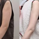 건대닥터쁘띠의원 | 건대닥터쁘띠 지방파괴주사 후기 - 팔뚝, 이중턱 효과, 부작용 (내돈내산, 대가성X)