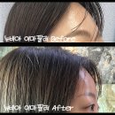 논현역 | 논현역 피부과 이마 필러 후기, 누운 이마 뉴비아 필러로 해결한 7일간 기록 (결절/부작용/부기/가격)