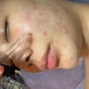 마포구청역 2번출구 | 마포구청역에스테틱 이모아에스테틱 여드름 플라즈마 관리 후기