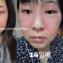 고일약국 | (피부) 힘들었던 얼굴 피부염, 완치까지의 피부일기 2