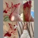 후암정형외과의원 | 발바닥 유리 찢어짐 봉합 수술 후기 (feat. 후암정형외과, 발바닥 유리 박혔을 때, 발바닥 마취주사)