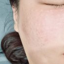 리즈약국 | [서울 마포] 홍대 피부과 엑셀브이레이저 리즈네 스킨부스터 2CC 통증 효과 부작용 주의사항 경과 후기