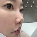 다모여 | 코수술 후 코필러 신사 코필러 잘하는 곳. 코수술 후 콧대 낮아서 고민인 분들 다 모여! 솔직후기