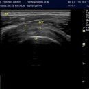 Full Thickness Tear of Rotator cuff 이미지