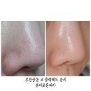 상동프라자약국 | 부천 상동 코블랙헤드 뷰티포톤피아 관리후기