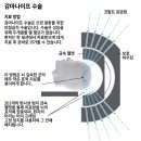 현대방사선기계 | [감마나이프 시술 1탄] 칼 없는 뇌수술, '감마나이프 시술'의 모든 것