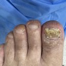 시원한마디의원 | 인천 주안역 발톱무좀,내성발톱 초기 치료 프로그램 이벤트 후기