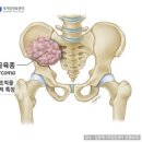 육종[sarcoma]의 정의· 연부조직 육종 이미지