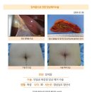 담낭제거수술후. 명치쪽에 극심한 통증으로 응급실을 방문했었다. 복부초음파를 하였고 작은 담석이 여러개 있었다... 이미지