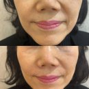 연세보람의원 | 강남 피어봄의원 쥬베룩볼륨 필러아닌 자가콜라겐으로 팔자주름 해결!