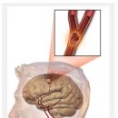 뇌혈관질환 뇌졸중 줄기세포치료 이미지