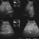 Abdomen 실제 초음파 이미지