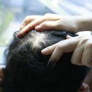 두피 탈모 아미치 0.3 수원점 이미지