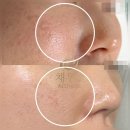 DT필 자동차정비 | 삼송역 피부관리 플라즈마 100샷 첫 방문 25% 할인 후기