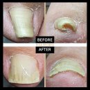 홀드핀칭 이미지