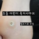 초등 어린이 족저사마귀 병원 대신 약국약으로 셀프 치료 경과 찐 후기 (티눈액 vs 콜로덤에스)