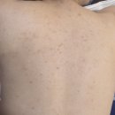 칼리 피부관리실 | 구미 피부관리 🌿 등드름 5회차 관리 후 달라진 피부, 실제 후기