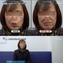 오래된 안면마비 후유증, 신림 구안와사 매선요법으로 - 바를정한방병원