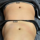인루나 에스테틱 | [창원 인루나 에스테틱] 뱃살 부자 창원 복부 슬리밍 관리 받고 온 날. 싸이블로 바디 슬리밍 하이푸...
