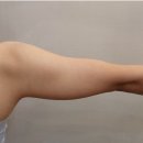 본식 3개월 전 신부, 팔뚝+뒷볼록 무한람스 상담 후기(내돈내산)