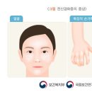 M34 전신경화증 Systemic sclerosis 이미지