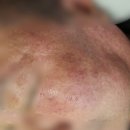 오체스킨케어 | 강릉에스테틱 검버섯관리 잘해주는 강릉 다이아 유천점 후기