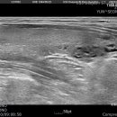 parallel and ovoid cystic and soild nodule 이미지