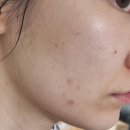 트러블세럼 추천, 금은화 화이트닝세럼으로 트러블 관리하기
