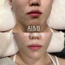 갈마동 에이아이앤비뷰티 대전웨딩관리 2030 리프팅 추천
