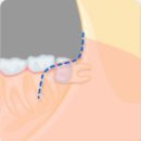 사람인치과의원 | ⭐️ 사랑니 발치 대장정 (1) (사랑니 발치 판단 기준, 가격, 후기)