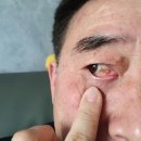 밝은에스안과의원 네이버블로그