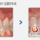 수플란트 이미지