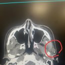 서울의원 | 이하선종양 (침샘종양) 수술후기 - 땡큐서울의원