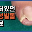 발톱이 왜 거기서 나와요? 내성발톱 치료 ※혐주의 이미지