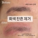 칭찬 | 울산 타투제거 : 문신제거 / 경주잔흔제거 : 무한 격려와칭찬드려요 🌈 / 제거 후기 짱많습니다