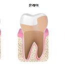 연세이로운치과보존과치과의원 네이버블로그