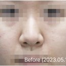 고운여성의원 | 미스코, 하이코 후기 낮은 콧대와 코끝 문제가 있던 환자